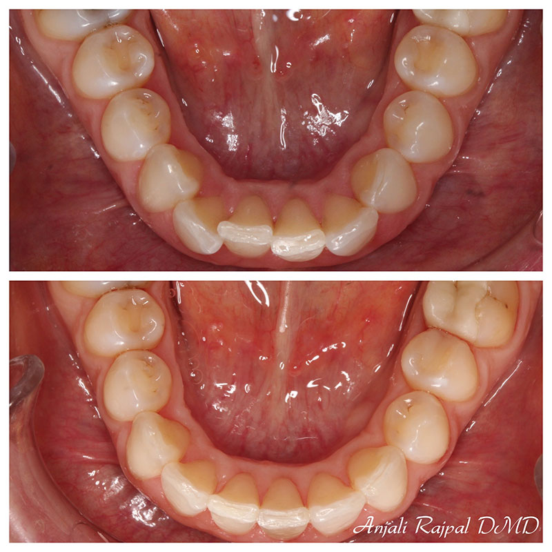 before and after invisalign beverly hills