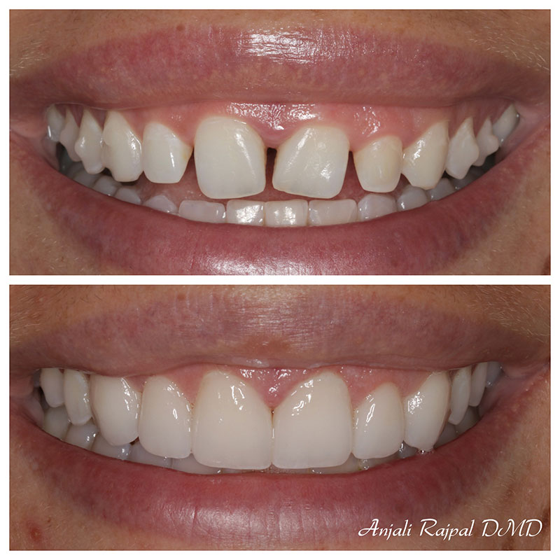 before and after invisalign treatment in beverly hills