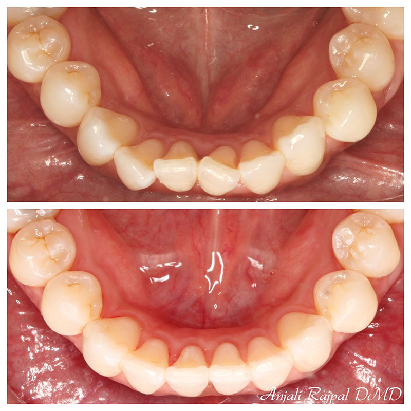 before and after invisalign beverly hills