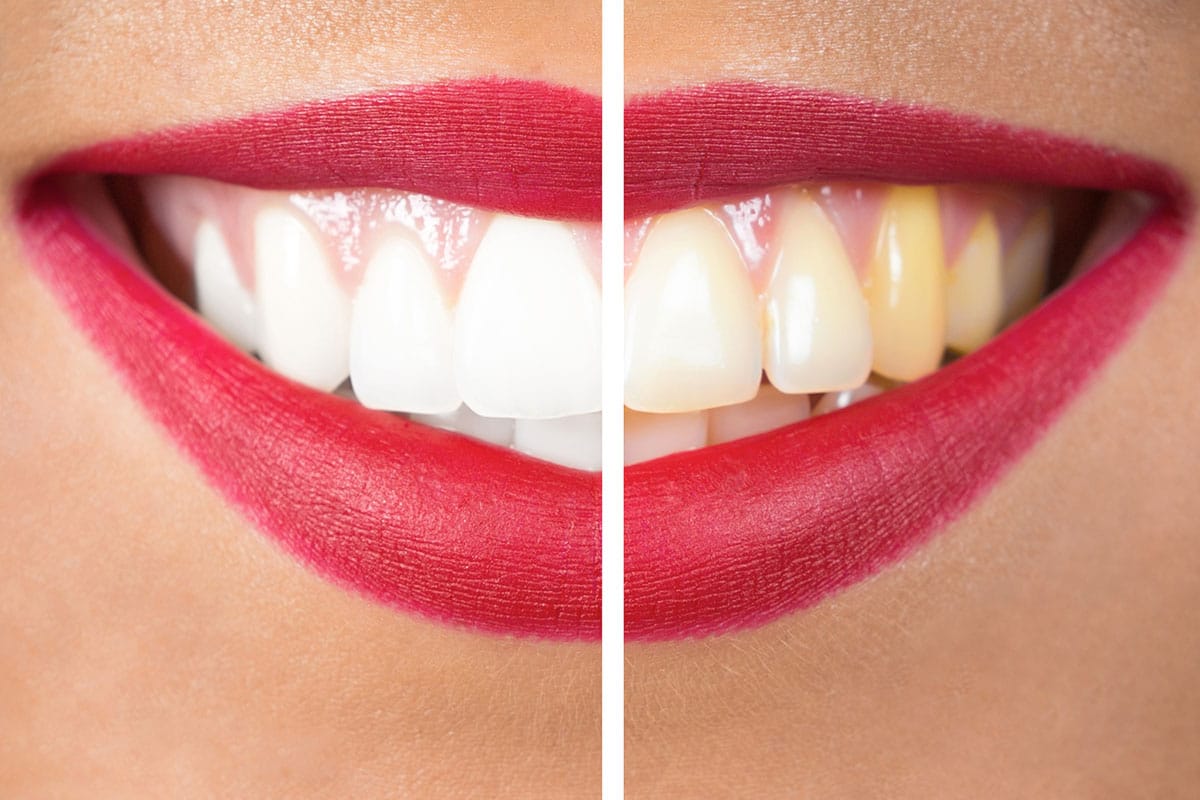 Teeth Whitening Beverly Hills, CA Beverly Hills Dental Arts