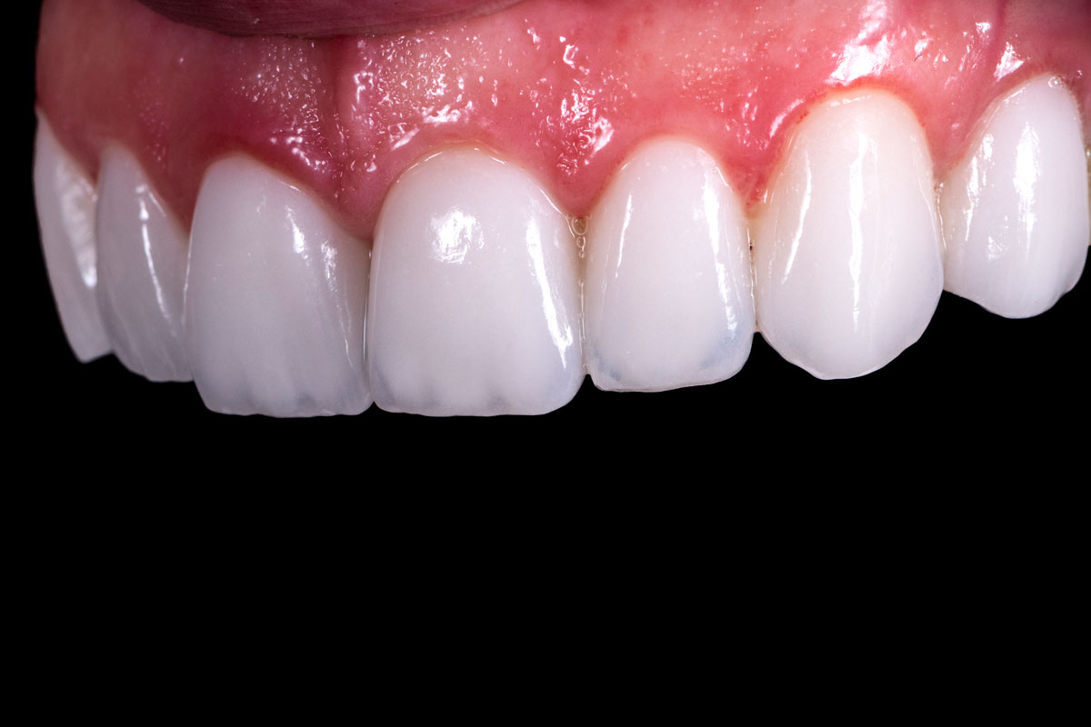 Porcelain Veneers Beverly Hills, CA Beverly Hills Dental Arts