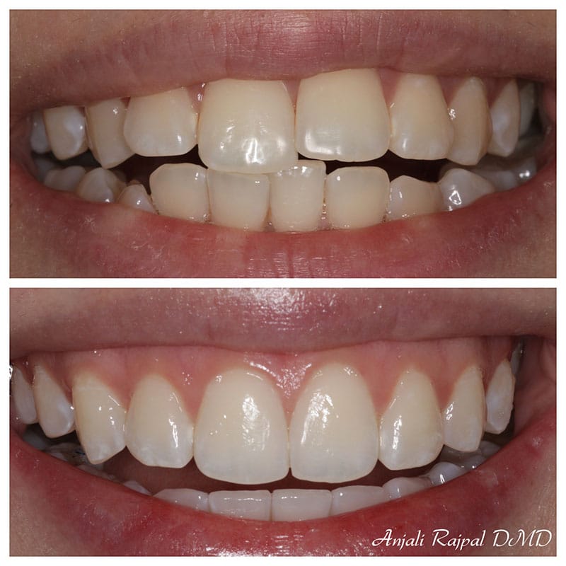 Before and after Invisalign treatment in Beverly Hills, showing straight teeth now.