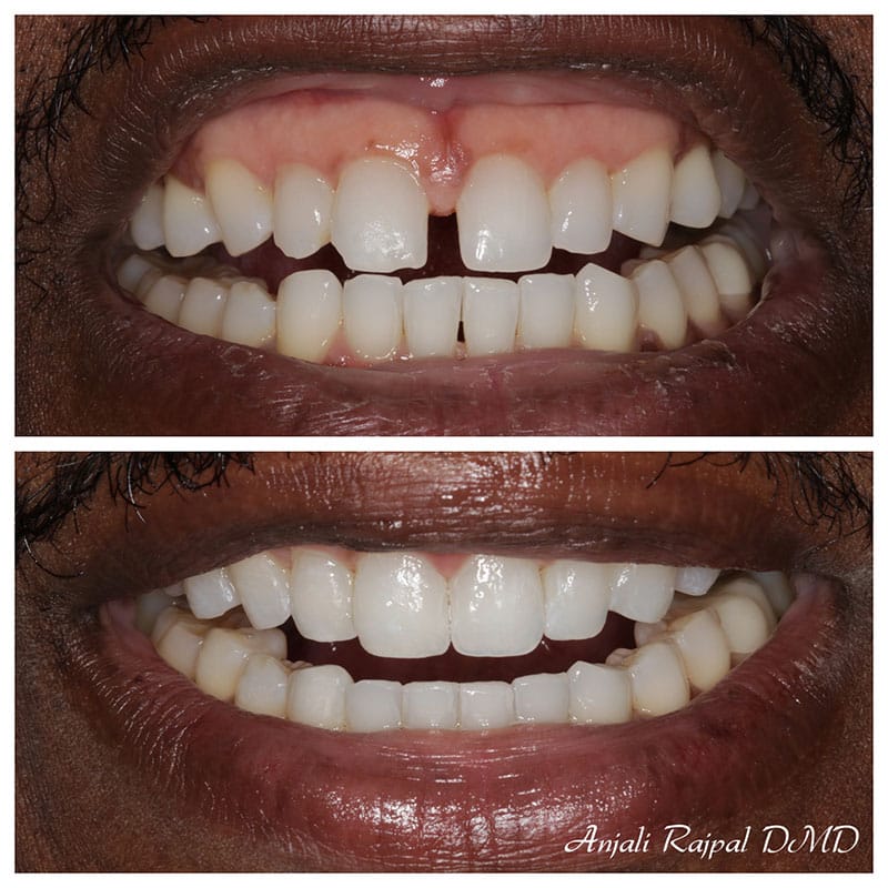 before and after invisalign treatment in beverly hills