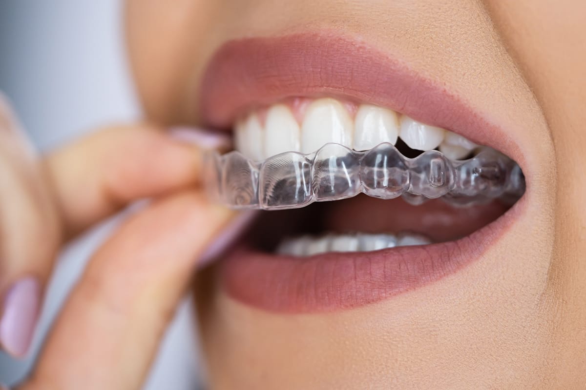 How Invisalign Can Improve Your Bite (Not Just Your Smile!)